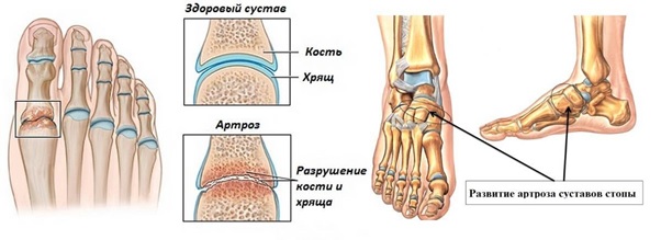 Артроз мелких суставов