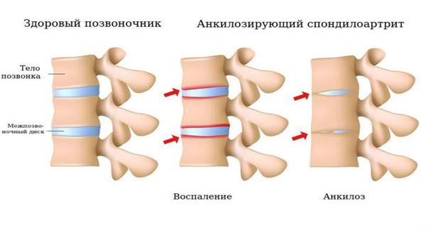 Болезнь Бехтерева