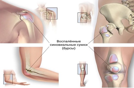 Бурсит