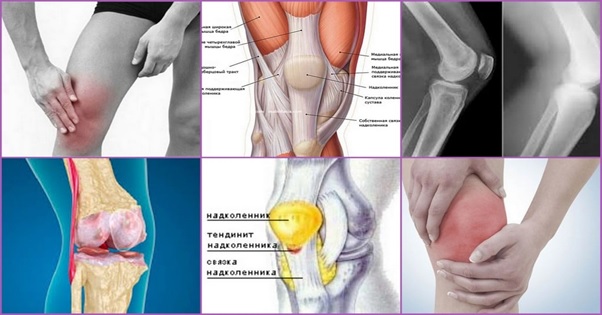 Воспаление колена
