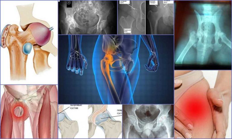 Воспаление тазобедренного сустава